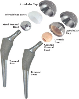 Modular options with uncemented Total Hip Replacement